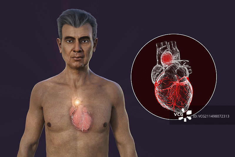 升主动脉瘤插图图片素材