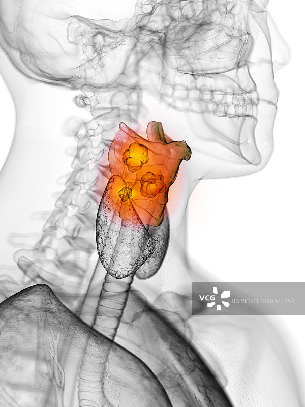 喉癌插画图片素材