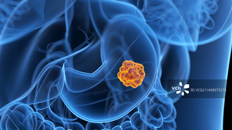 胃癌插图图片素材