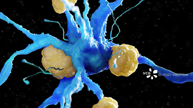 有淀粉样斑块的神经细胞插图图片素材