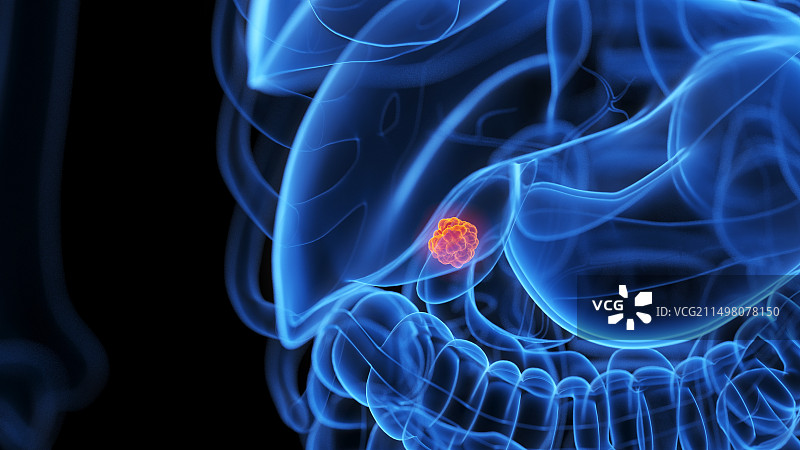 胆囊肿瘤插图图片素材