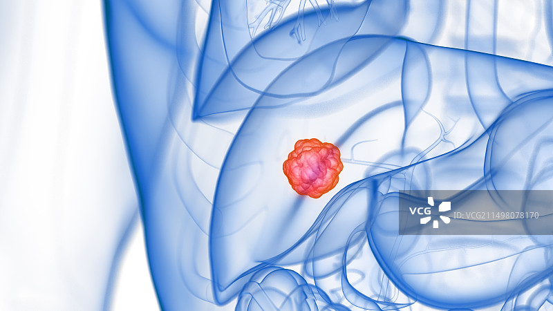 肝肿瘤，图示图片素材