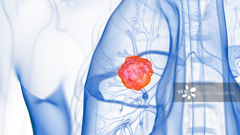 肺部肿瘤插图图片素材