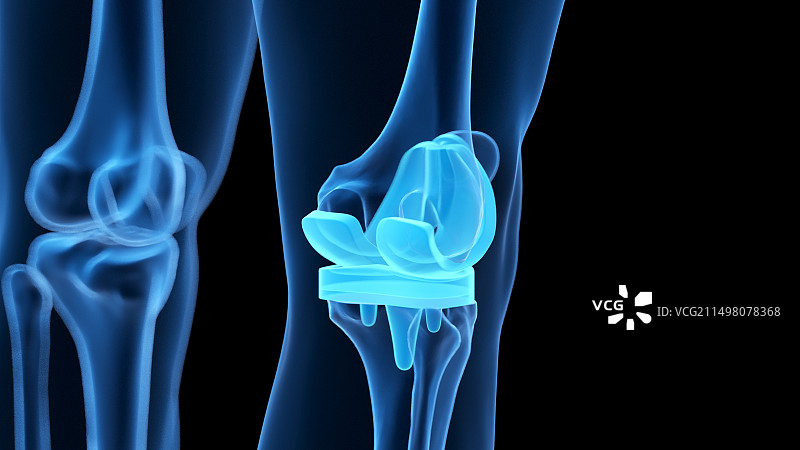 膝关节置换术插图图片素材