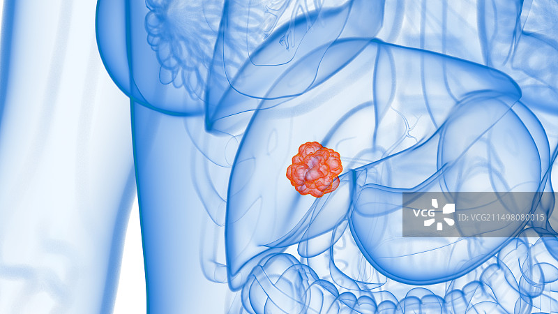 肝癌，图示图片素材