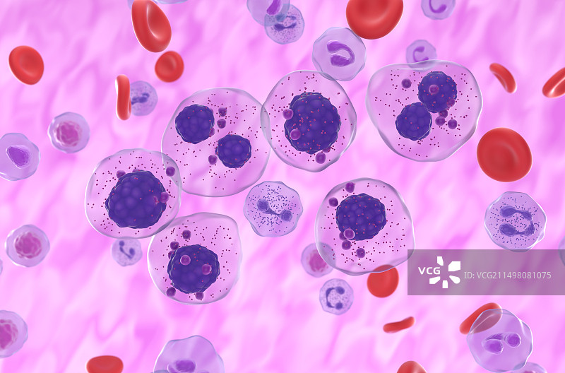 多发性骨髓瘤插图图片素材