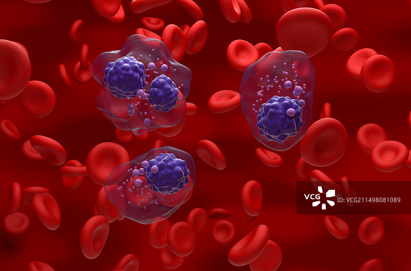 多发性骨髓瘤插图图片素材