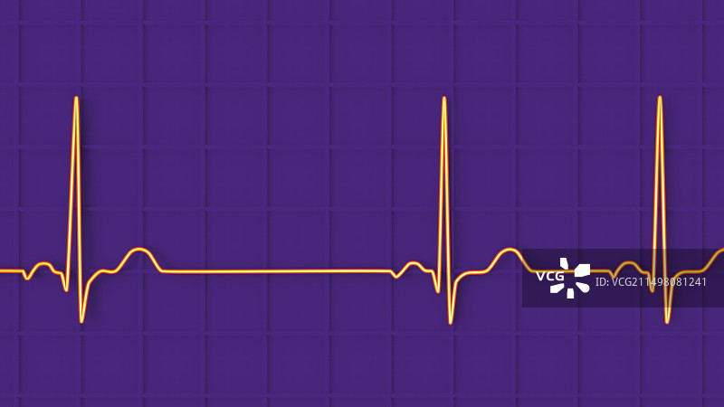 窦性心律不齐心跳节律图图片素材