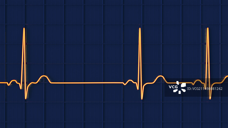 窦性心律不齐心跳节律图图片素材