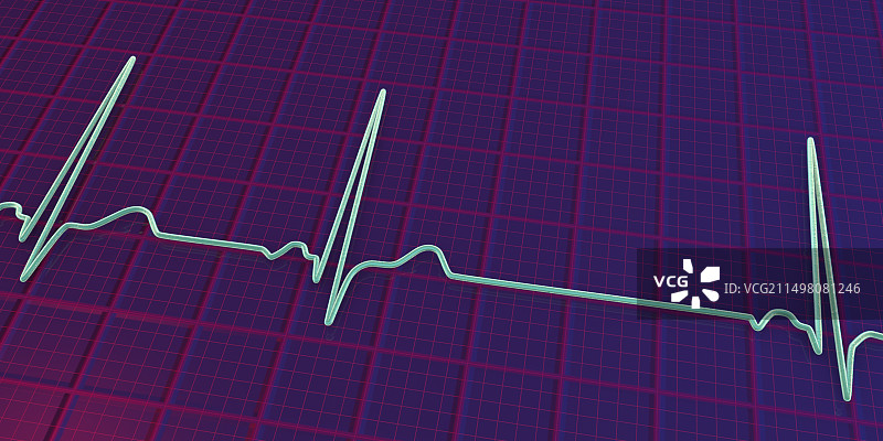 窦性心律不齐心跳节律图图片素材