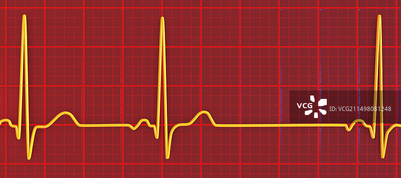 窦性心律不齐心跳节律图图片素材