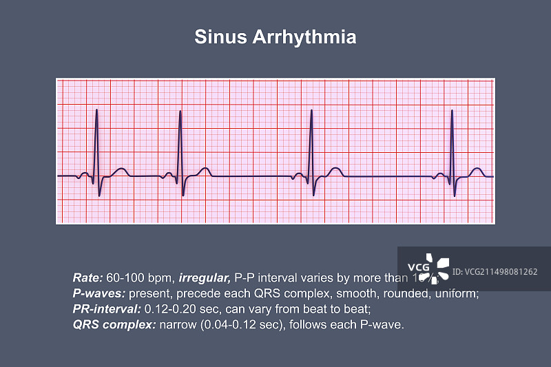窦性心律不齐心跳节律图图片素材
