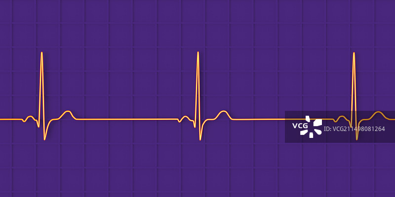窦性心动过缓心跳节律图图片素材