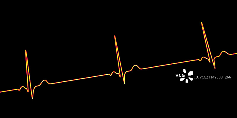 窦性心动过缓心跳节律图图片素材