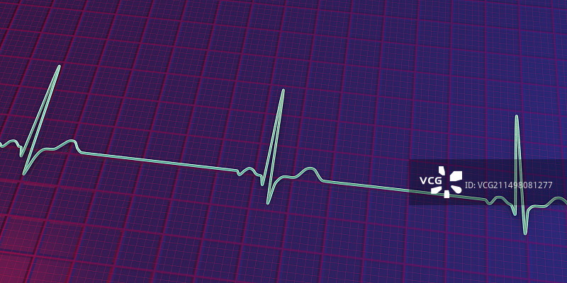 窦性心动过缓心跳节律图图片素材