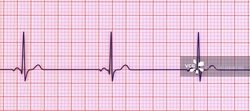 窦性心动过缓心跳节律图图片素材