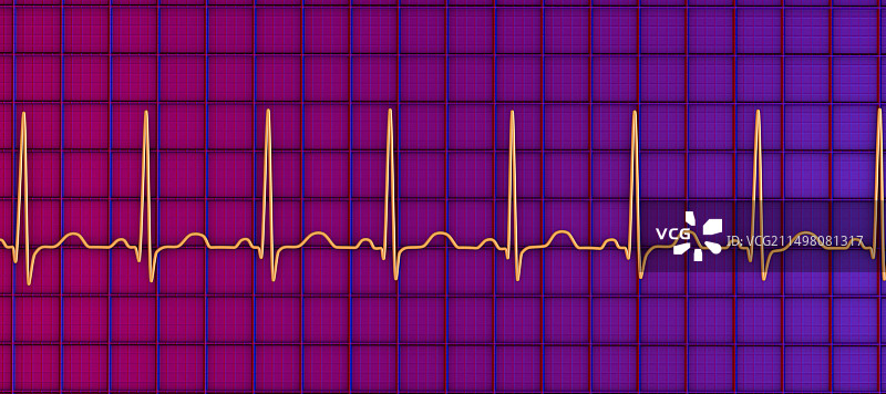 窦性心动过速心跳节律图图片素材