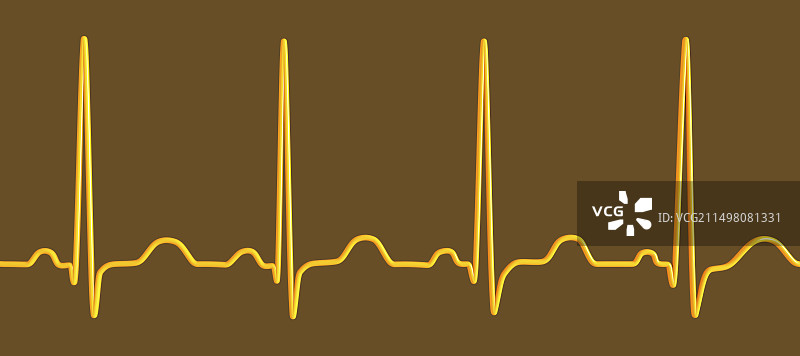 窦性心动过速心跳节律图图片素材