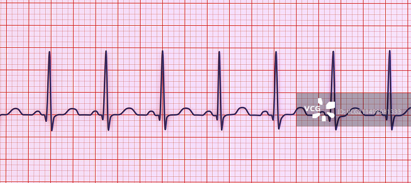 窦性心动过速心跳节律图图片素材