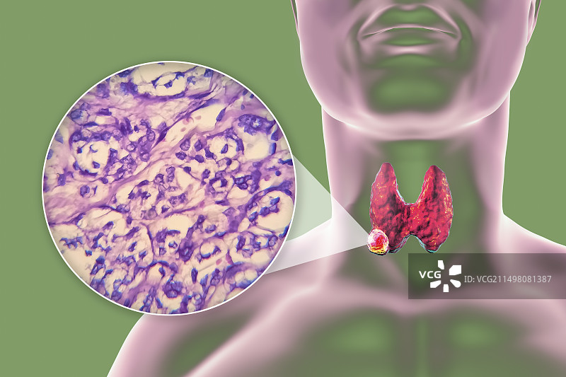 甲状腺癌图示图片素材