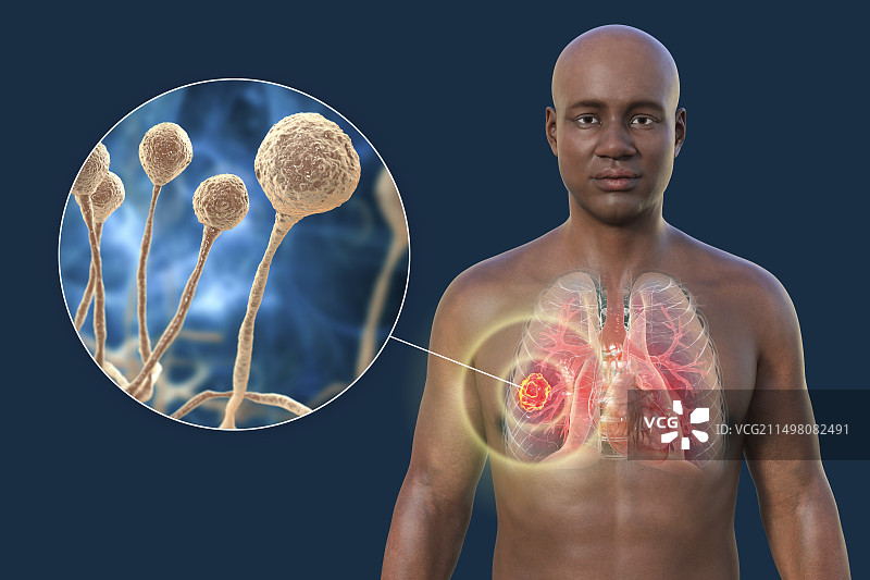 肺部毛霉菌病病变，图示图片素材