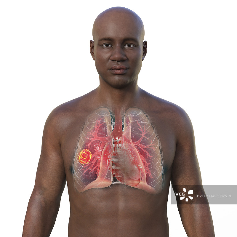 肺部毛霉菌病病变，图示图片素材