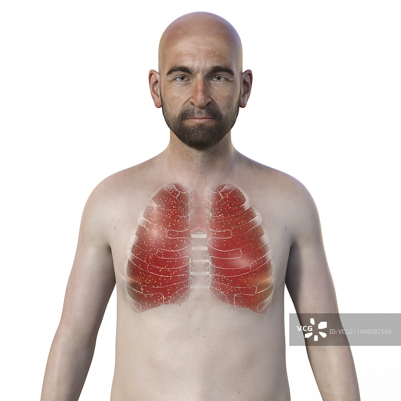 粟粒性结核病插图图片素材