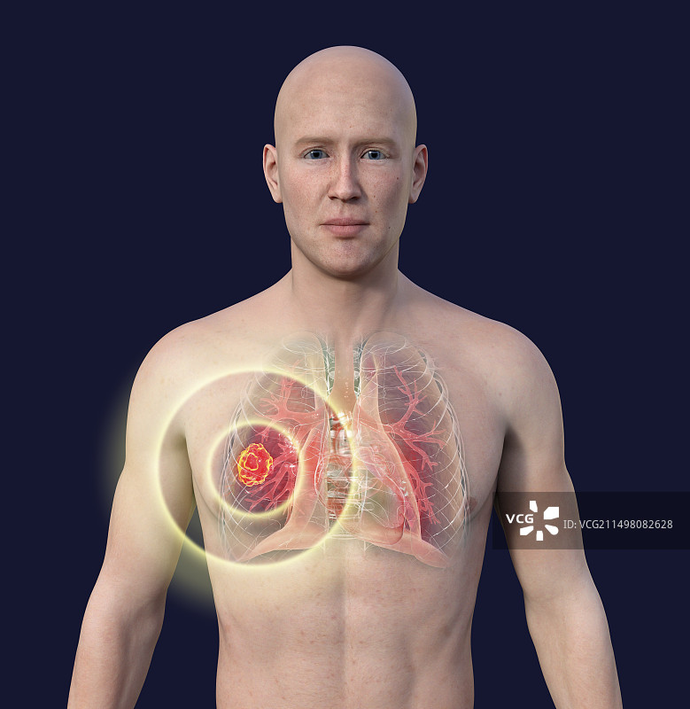 肺部毛霉菌病病变，图示图片素材