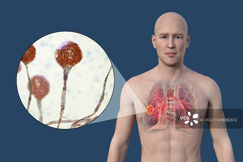 肺部毛霉菌病病变，图示图片素材