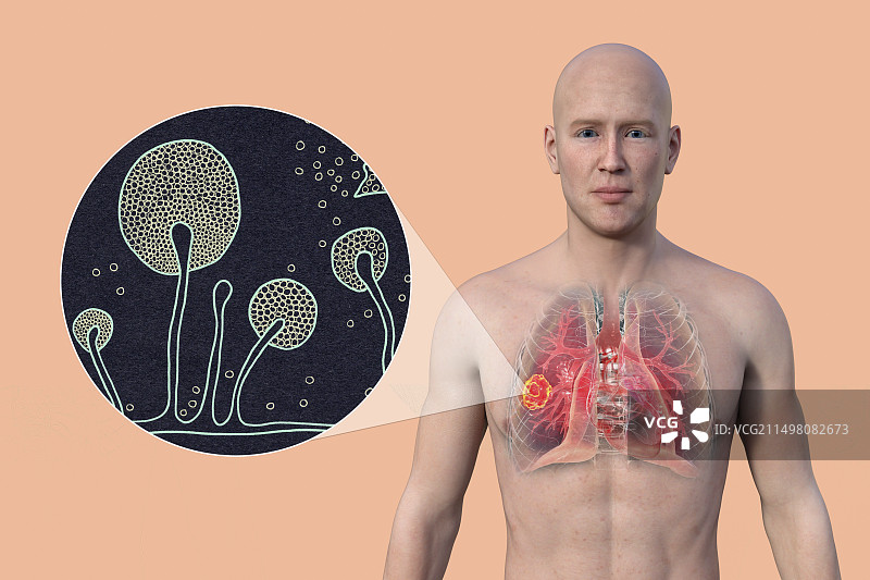 肺部毛霉菌病病变，图示图片素材