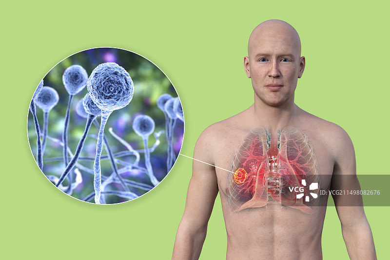 肺部毛霉菌病病变，图示图片素材