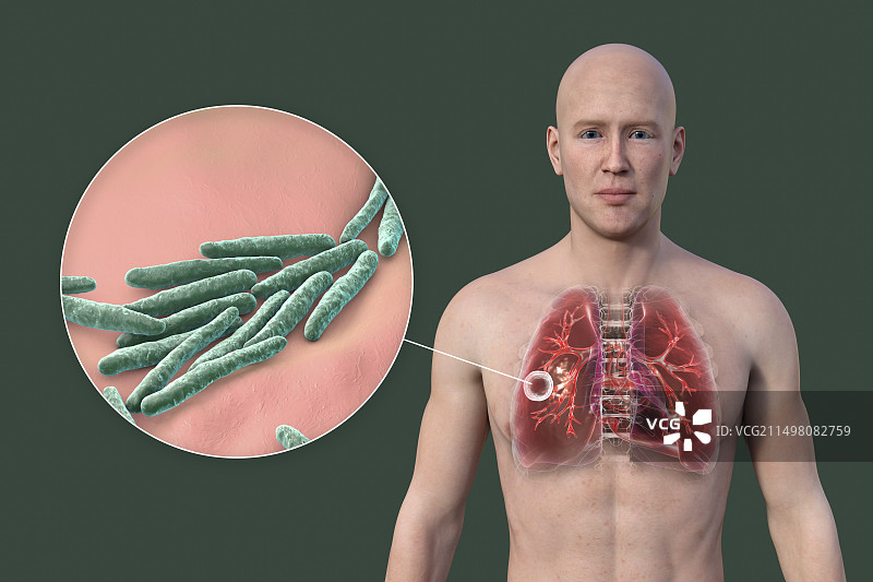 肺部空洞性结核病图示图片素材