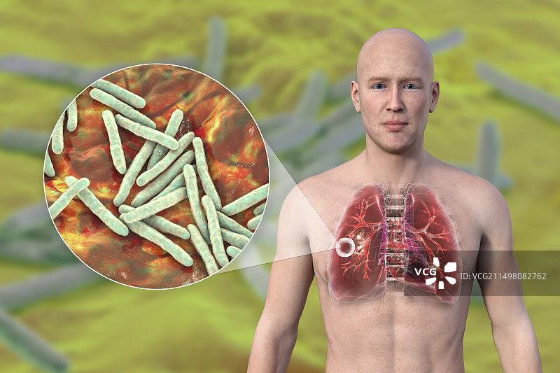肺部空洞性结核病图示图片素材