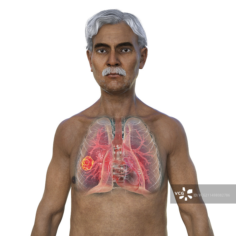 肺部毛霉菌病病变，图示图片素材