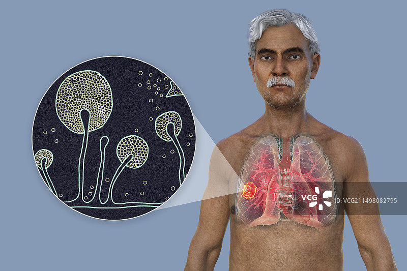 肺部毛霉菌病病变，图示图片素材