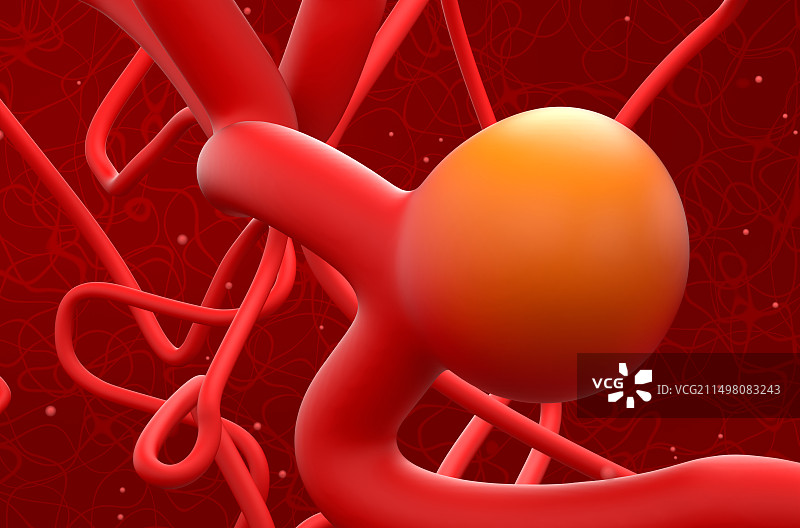 脑动脉瘤插图图片素材