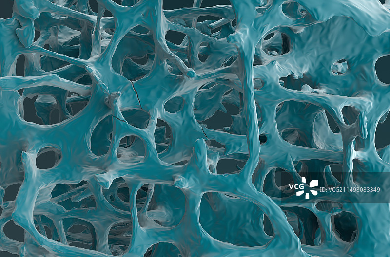 骨质疏松骨组织骨折图图片素材