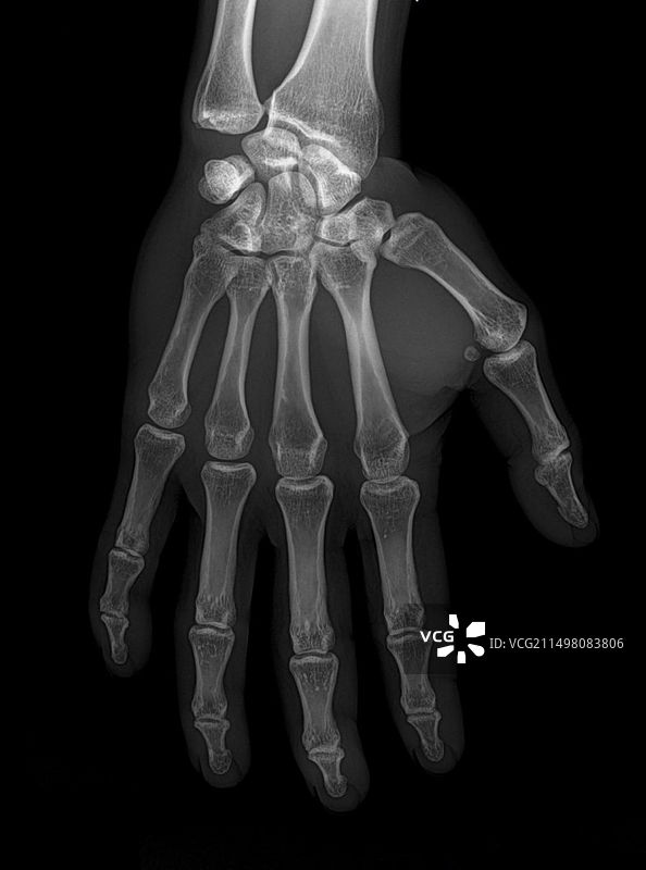 健康的手部X光片图片素材