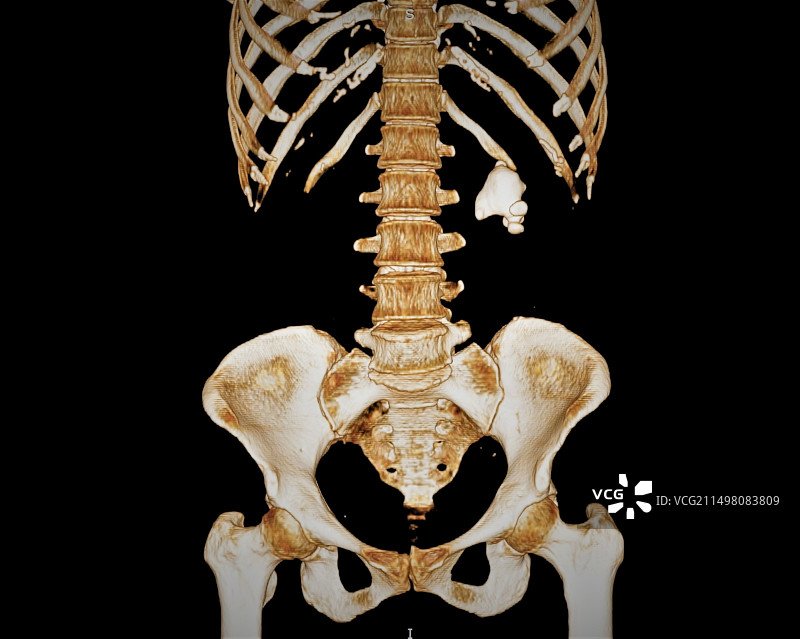 肾结石3D CT扫描图片素材