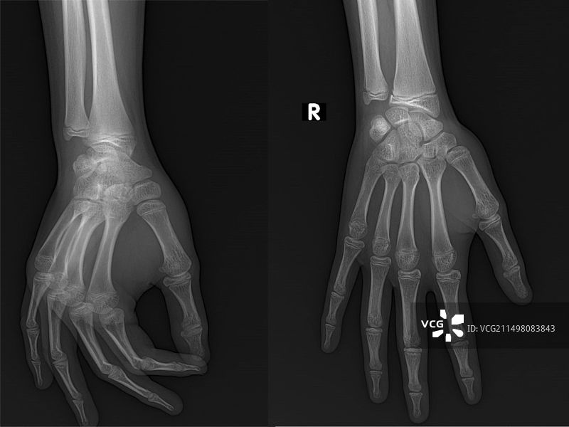 健康的手部X光片图片素材