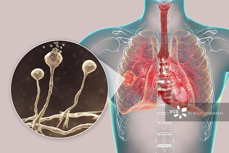 肺部毛霉菌病病变，图示图片素材