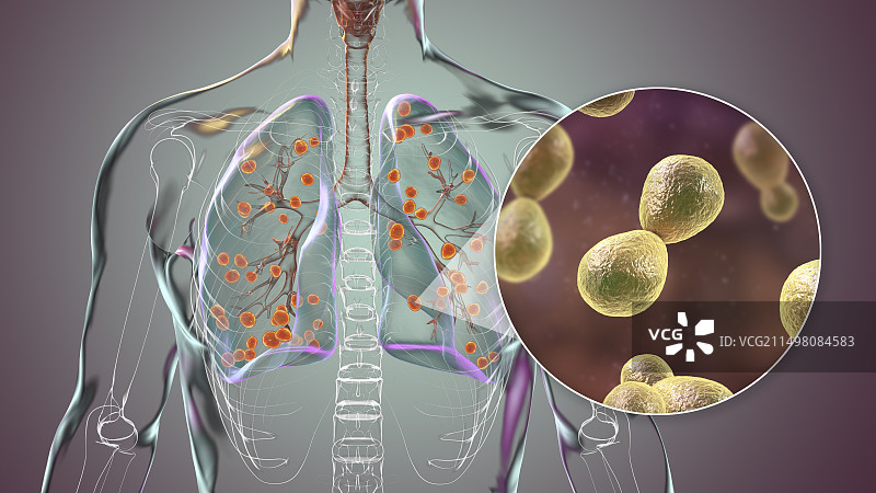 肺组织胞浆菌病插图图片素材