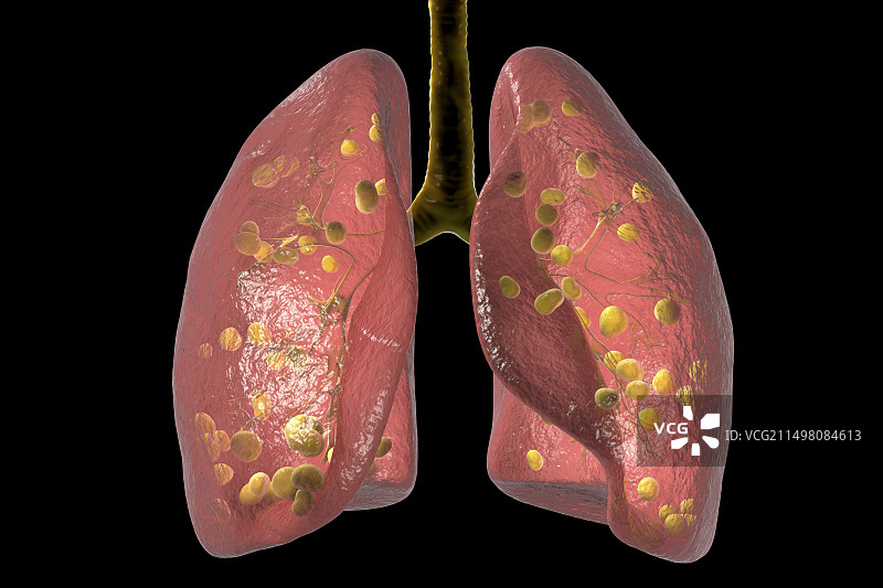 肺组织胞浆菌病插图图片素材