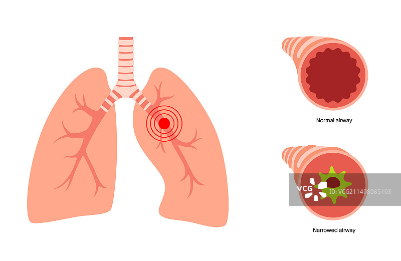 支气管炎肺部疾病插图图片素材
