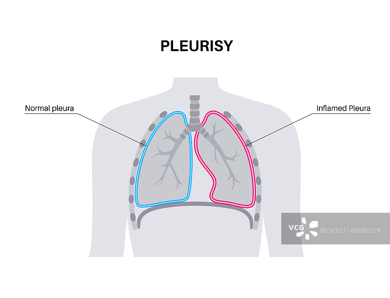 胸膜炎插图图片素材