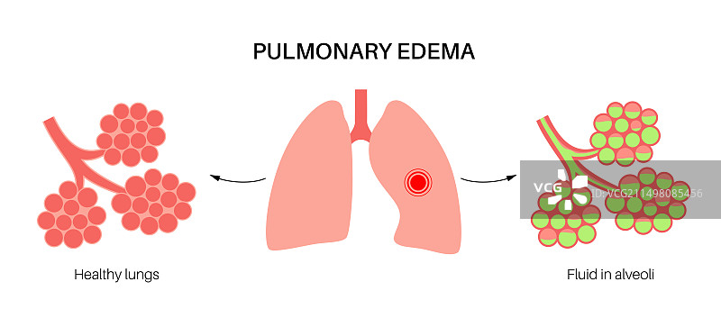 肺水肿，插图图片素材