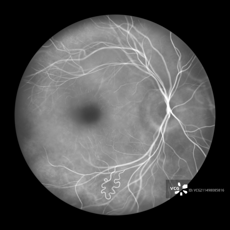 视网膜动静脉畸形插图图片素材
