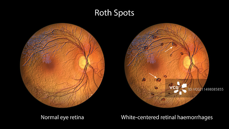 视网膜上的罗斯斑点图片素材