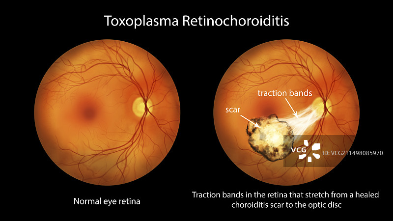 弓形虫性视网膜脉络膜炎插图图片素材