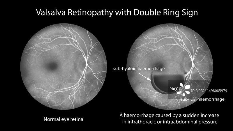 瓦尔萨瓦视网膜病变插图图片素材